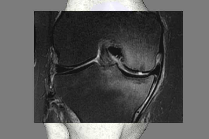 torn meniscus knee