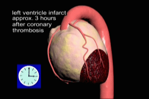 myocardial infarction (heart attack)