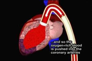 Cardiogenic Shock Balloon Pump