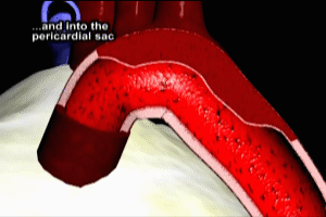 Aortic Dissection Descending