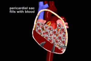 Cardiac Tamponade Hemorrhagic