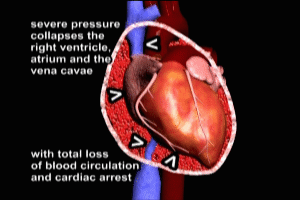 Cardiac Tamponade Traumatic