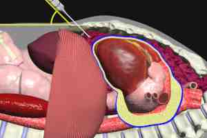 Pericardiocentesis Video - Trial Image Inc.