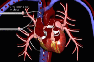 Cardiac Emptying on Bypass