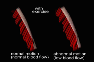 Ventricular Wall Motion and Myocardial Ischemia