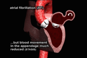 atrial fibrillation animation gif