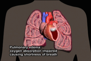 Congestive Heart Failure