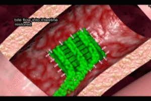 Hepaticojejunostomy