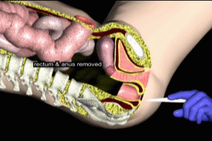 Abdominoperineal Resection