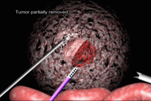 Nephrectomy Vascular Control