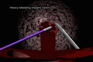 Nephrectomy Hemorrhage