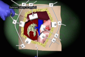 Nephrectomy