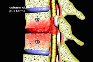 Spinal Infection