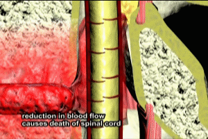 Spinal Vasculitis