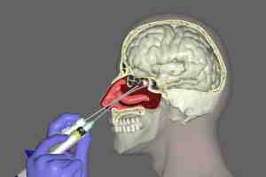 sinus polyp removal