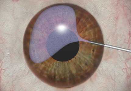 eye injection