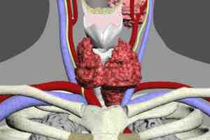 glomus tumor