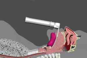 endotracheal intubation