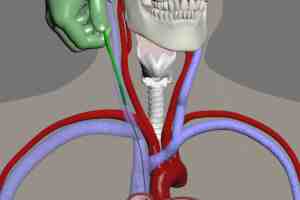 central catheter