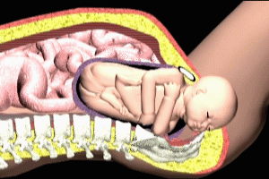 Fetal Shoulder Dystocia