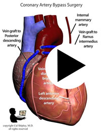 Coronary Artery Bypass Grafts