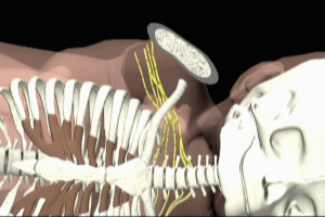 Brachial Plexus Strain in Fetal Shoulder Dystocia