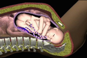Fetal Hypoxia Umbilical Cord Compression im Fetal Shoulder Dystocia