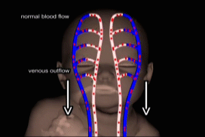 Fetal Hypoxia Venous Obstruction in Fetal Shoulder Dystocia