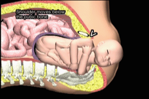Mcroberts Maneuver for Fetal Shoulder Dystocia