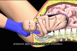 Corkscrew Maneuver for Fetal Shoulder Dystocia