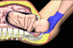 Zavanelli Maneuver for Fetal Shoulder Dystocia