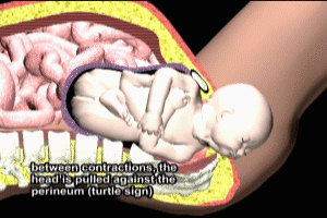 The Turtle Sign im Fetal Shoulder Dystocia