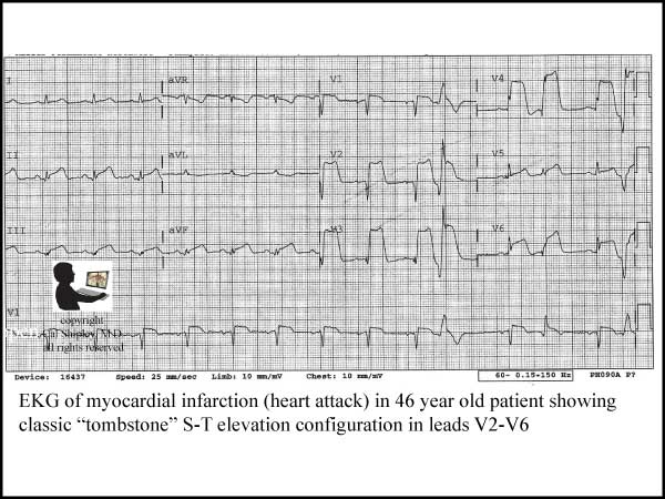 Myocardial Infarction EKG
