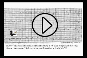 Myocardial Infarction EKG