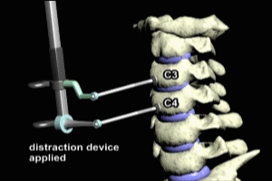 Cervical Fusion and Discectomy