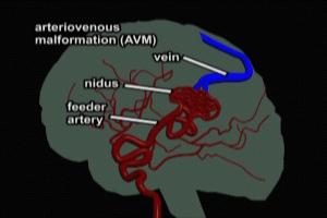 Arteriovenous Malformation