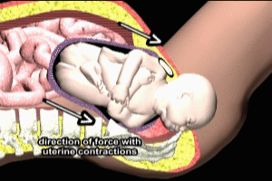 Turtle Sign in Shoulder Dystocia