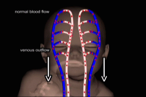 Fetal Hypoxia Venous Compression