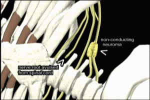 Brachial Nerve Avulsion and Neuroma