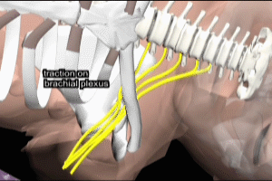 Brachial Plexus Strain Posterior Shoulder