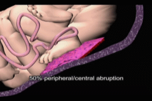 Placental Abruption Fetal Bradycardia