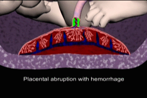 Placental Abruption with Blood Sequestration