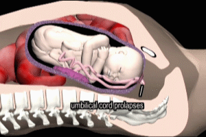 Umbilical Cord Prolapse Overt