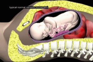 Fetal Movement Myoclonus