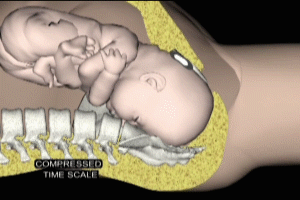 Fetal Head Molding