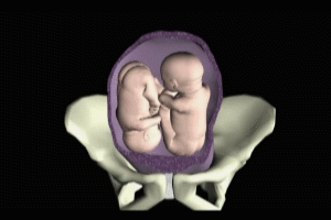 Twin Intrauterine Anatomy