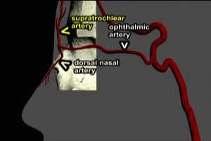 Ophthalmic Artery