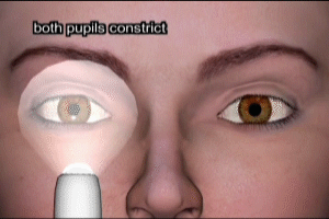 Afferent Pupillary Defect