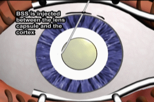 Cataract Surgery