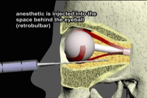 Retrobulbar Anesthesia of the Eye